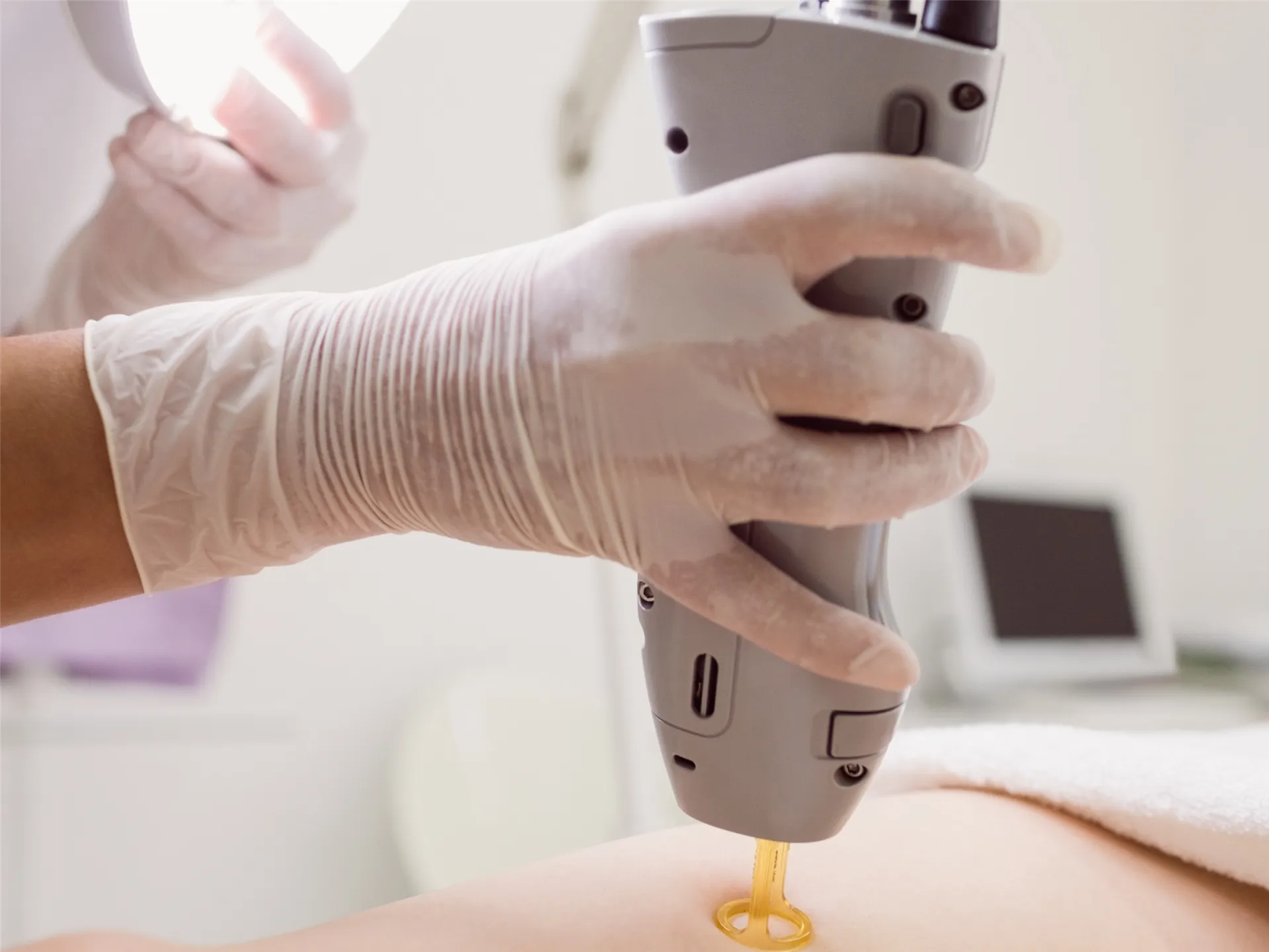 Elektroepilasyon (İğneli Epilasyon)